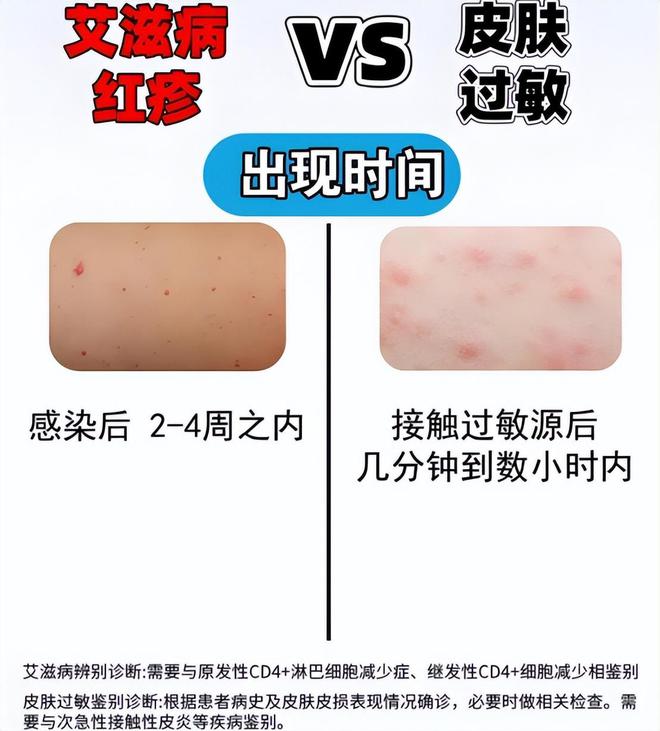 一旦感染艾滋病，多久能被发觉？可能多数人以为是皮肤病，要分清