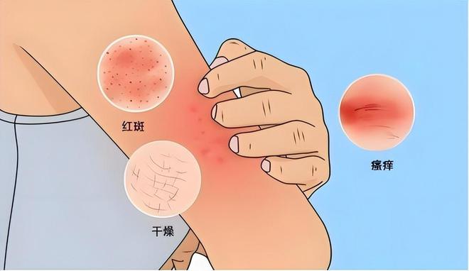 一旦感染艾滋病，多久能被发觉？可能多数人以为是皮肤病，要分清